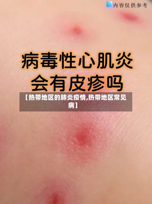 【热带地区的肺炎疫情,热带地区常见病】-第2张图片